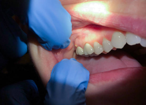 Best Emergency Dental Care for Sports Injuries in Carnegie, PA